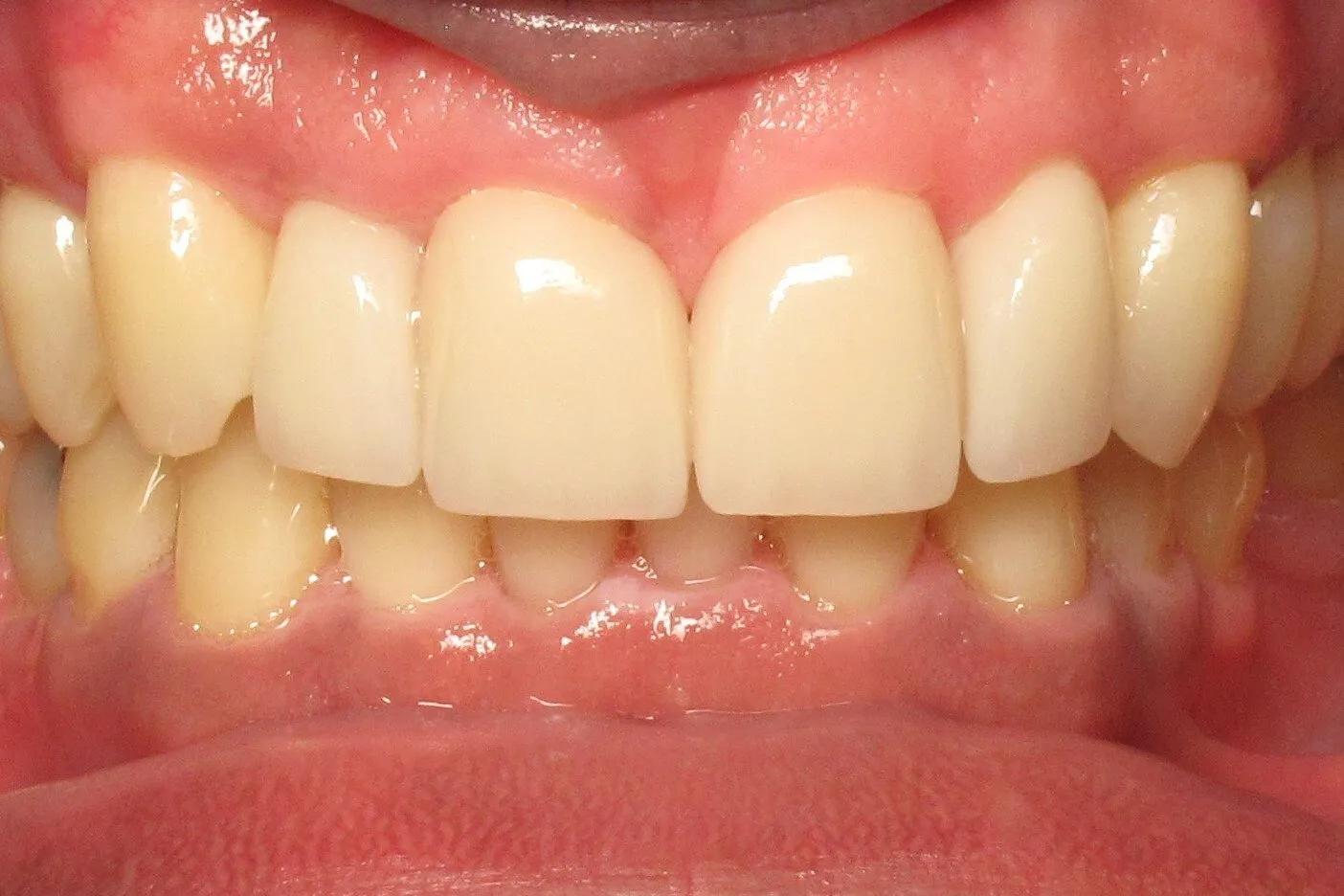 Close-up view of natural-looking dental implants and crowns in upper front teeth during oral examination.
