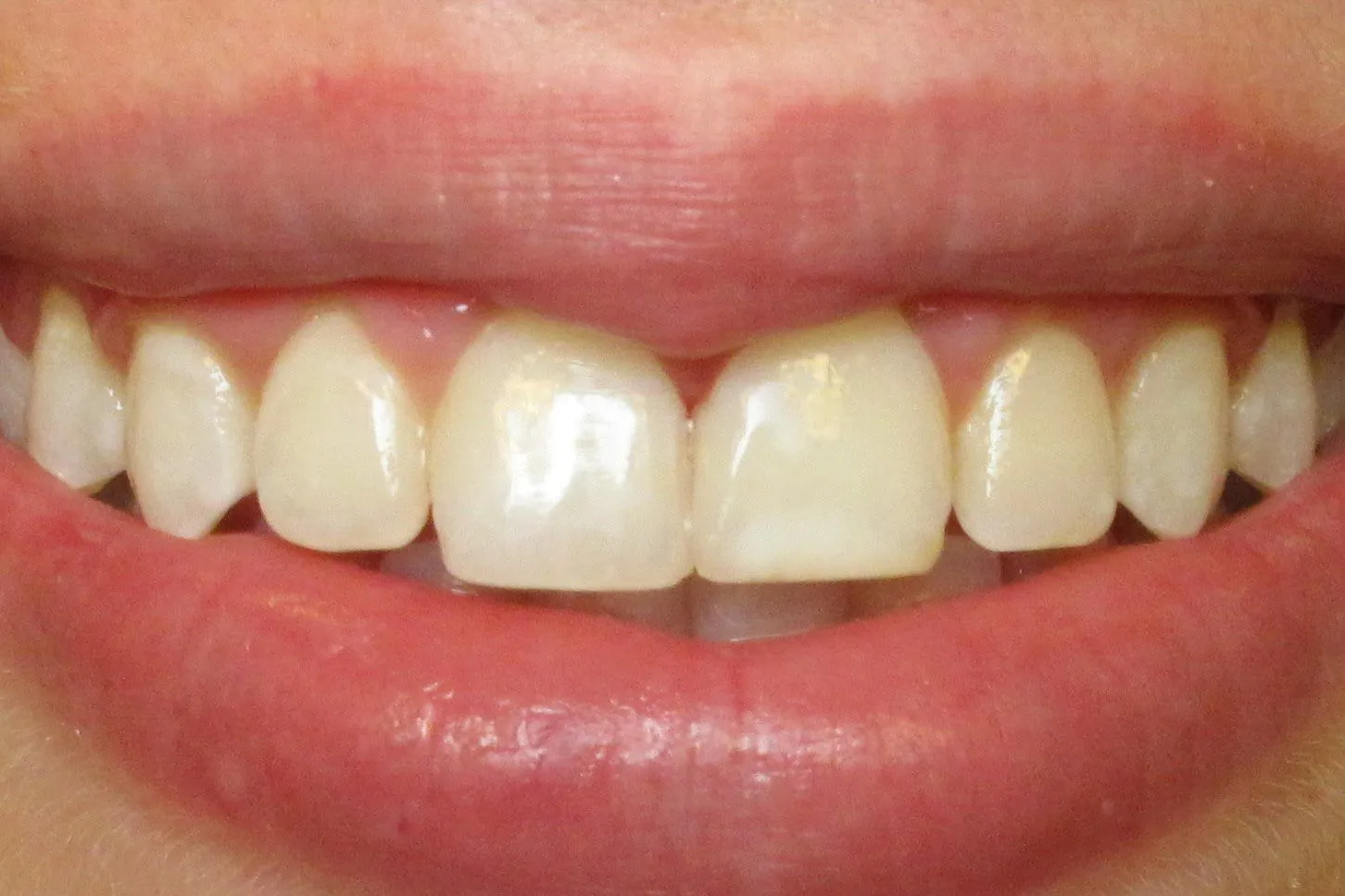 Close-up of a person's smile showing natural-looking white teeth and healthy gums.