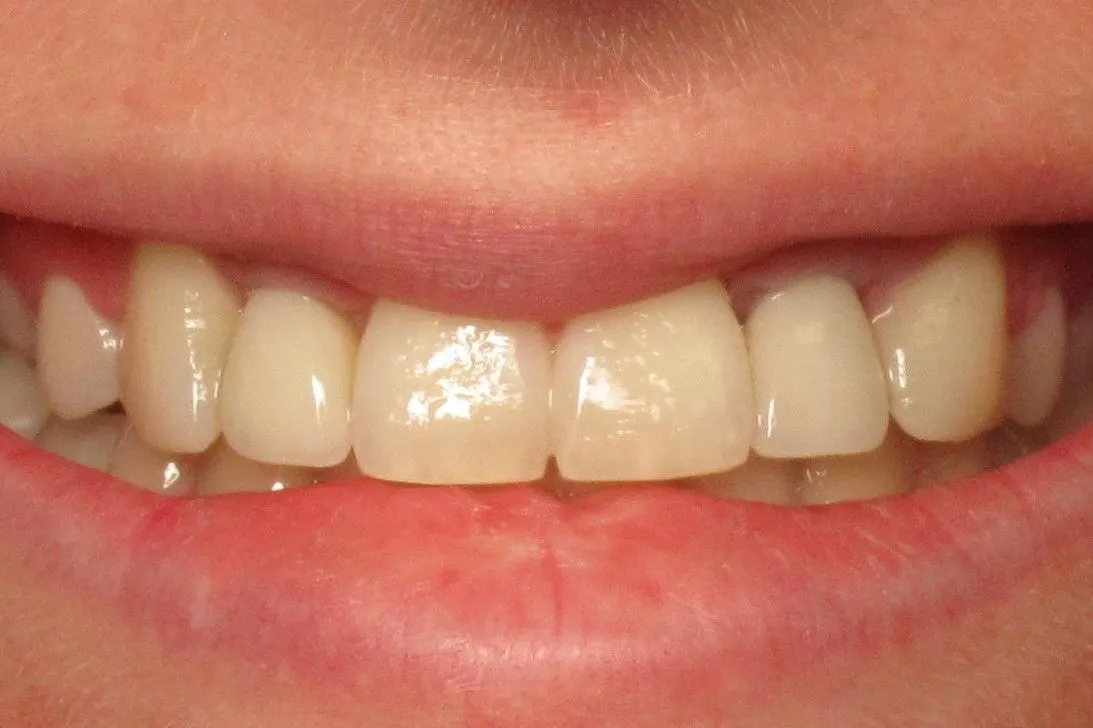 Close-up of a person's smile showing upper front teeth and lips in a dental context.