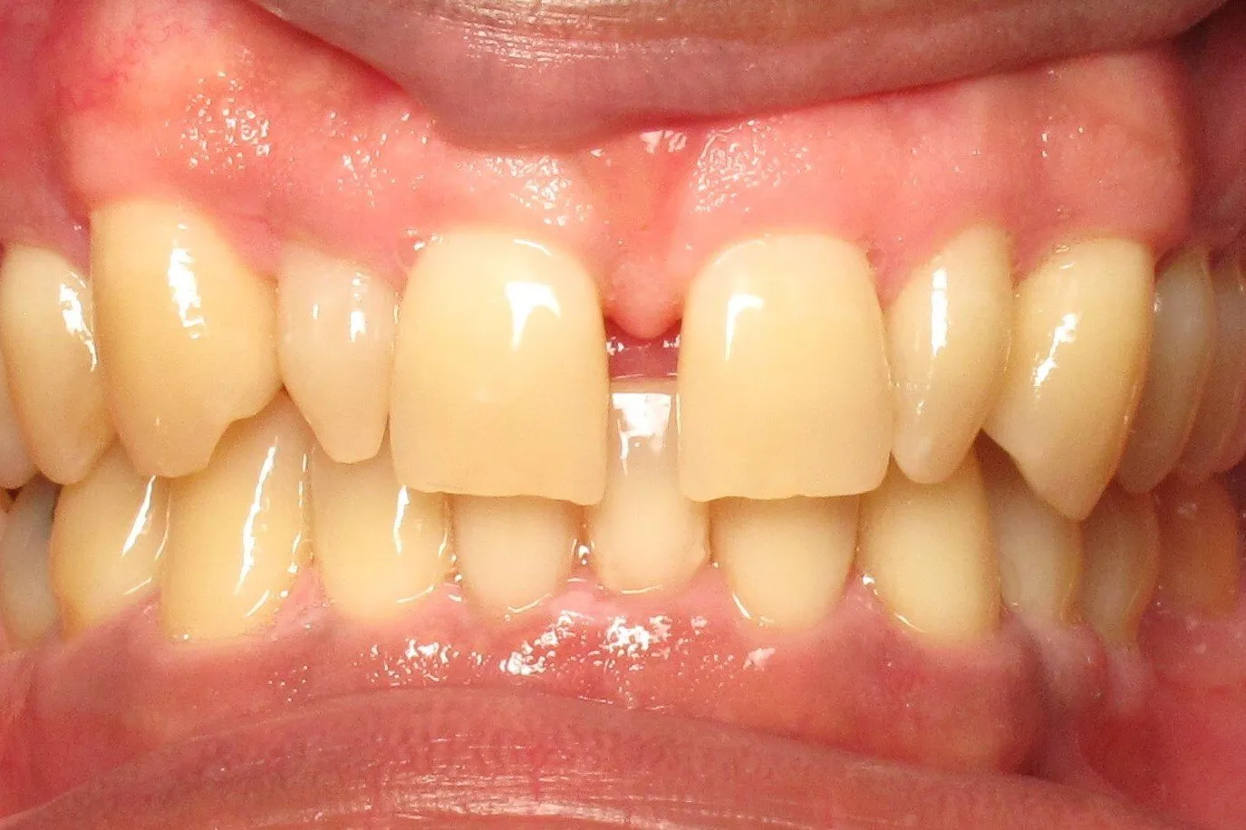 Close-up of dental patient's upper and lower teeth showing gap between front teeth and discoloration.
