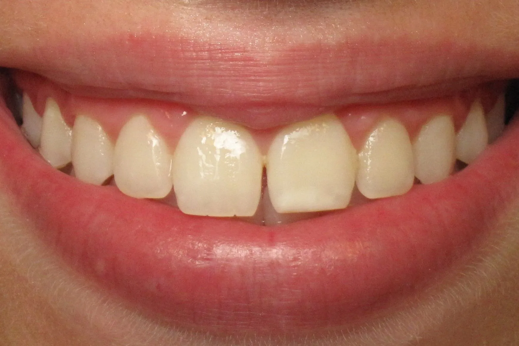 Close-up of person's smile showing natural teeth and gum line in dental context.