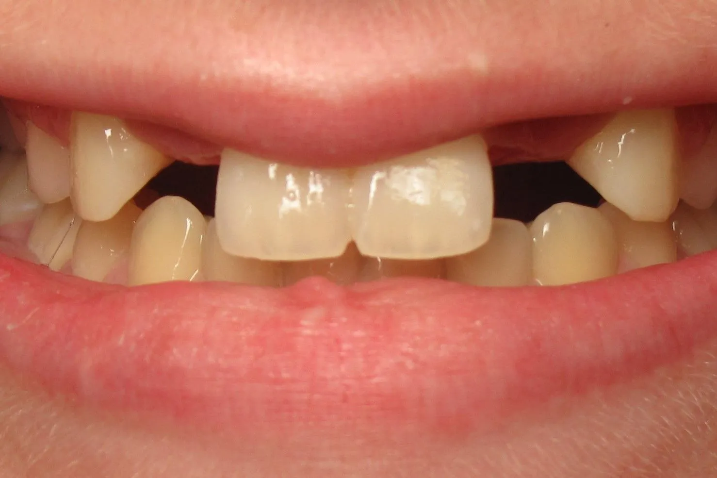 Close-up of teeth showing gaps between front upper teeth and discoloration, dental concern.