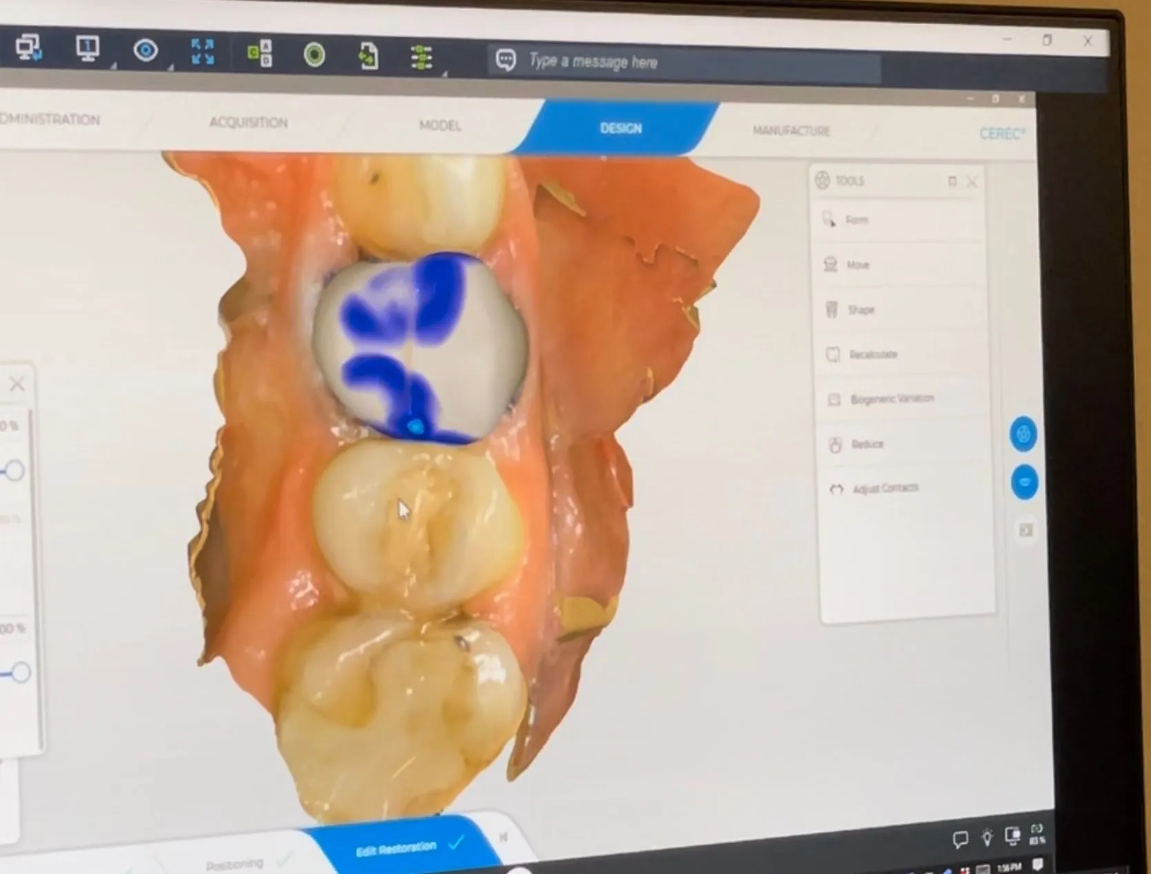 3D dental imaging software displaying anatomical scan of jaw and teeth structure on computer screen.
