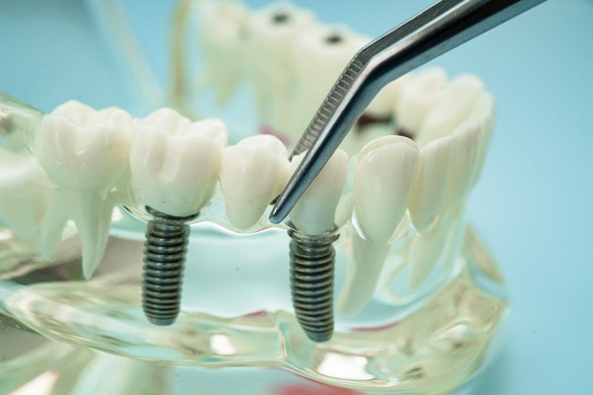 Dental implant model showing two titanium screws in transparent jaw replica against blue background.