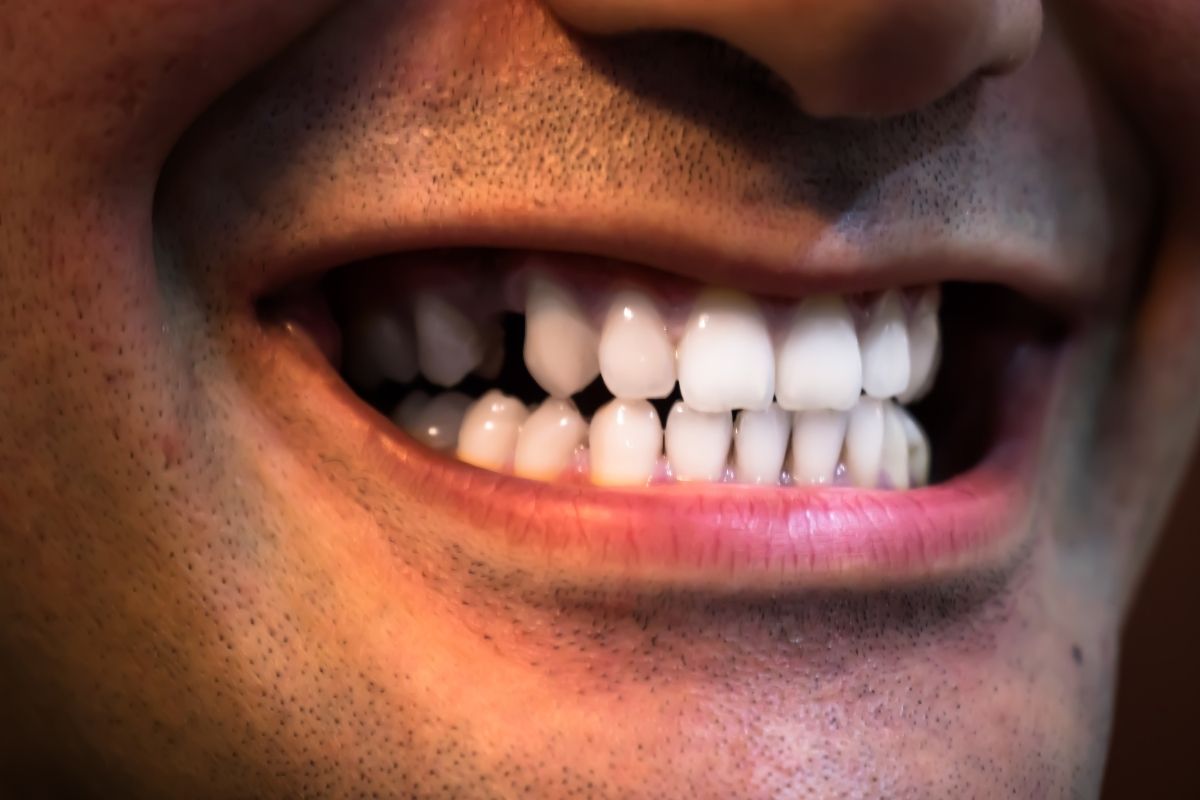 Close-up of person smiling, displaying bright white teeth and healthy gums.