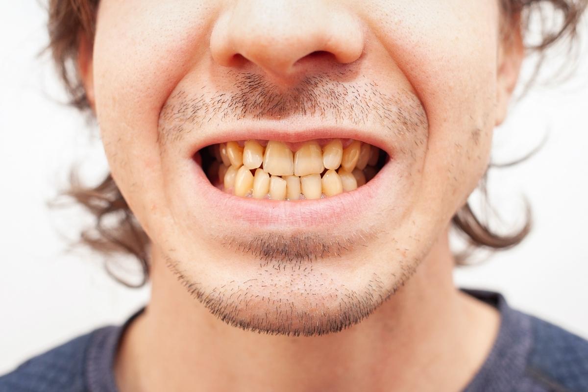 Teeth Stains