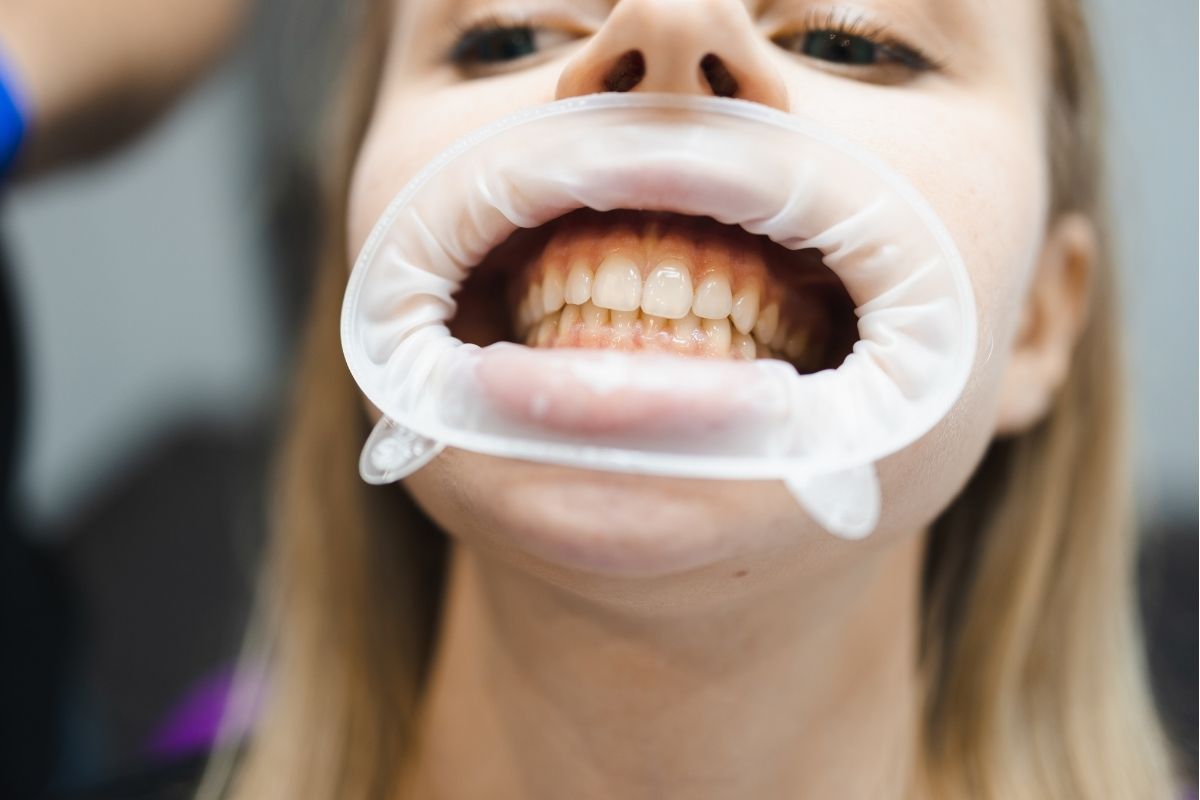 staining teeth
