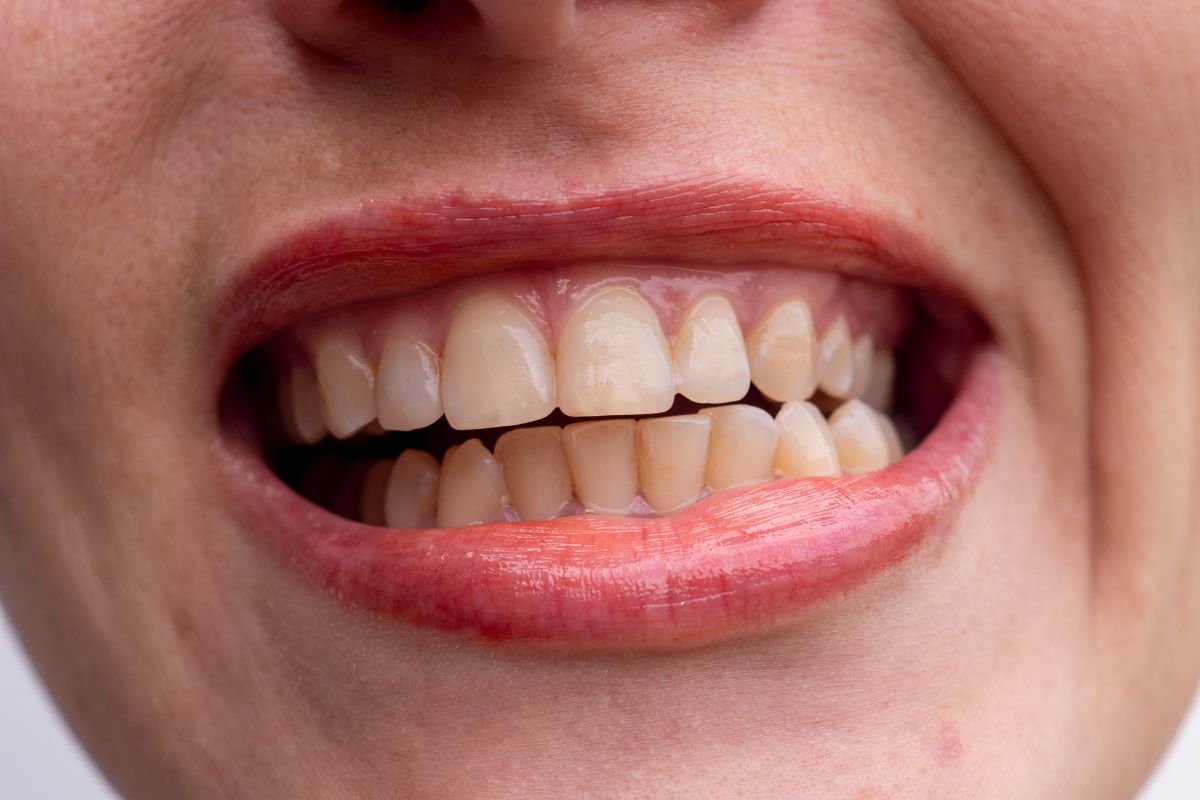 Yellowing Teeth