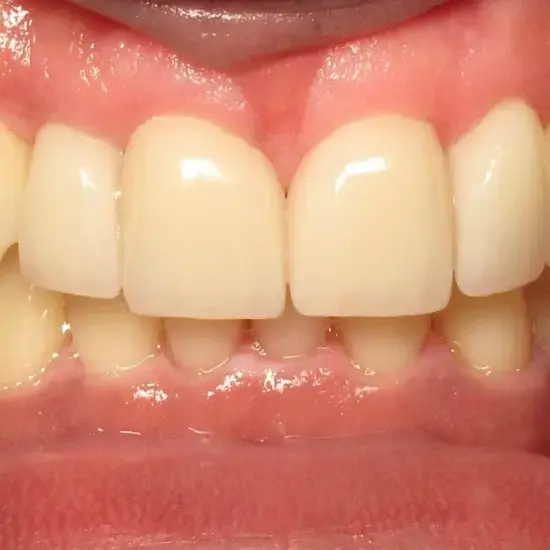 After dental veneers, patient's smile shows four upper front teeth with improved spacing and size.