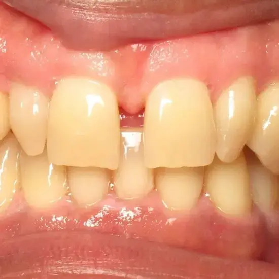 Before veneers treatment showing gap between upper front teeth and undersized tooth structure.