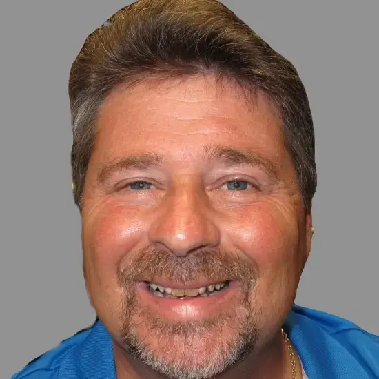 Before veneers patient smiling with stained and misaligned teeth in Allentown.