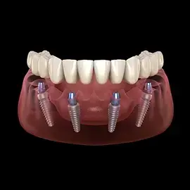 All-on-four dental implants diagram showing prosthetic teeth supported by four implant posts in the jawbone.