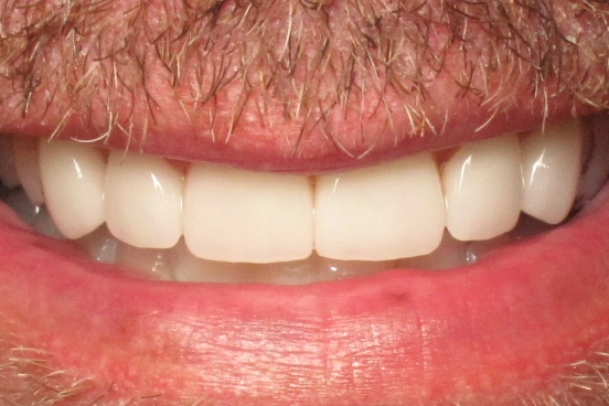 after dental veneers