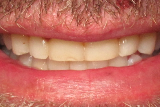 before dental veneers