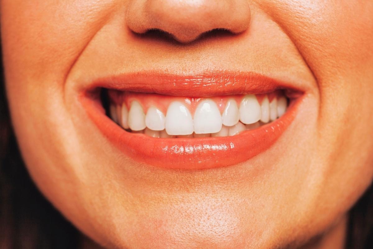 What to Eat After Teeth Whitening
